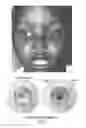 Fig. 03 - TISSUE-DERIVED SCAFFOLDS FOR CORNEAL RECONSTRUCTION
