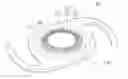 Fig. 01 - Adjustable intraocular lens