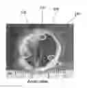 Fig. 01 - Decalcifying heart valve