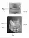 Fig. 07 - Decalcifying heart valve