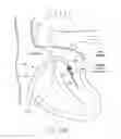 Fig. 32 - Implantable device and delivery system for reshaping a heart valve annulus