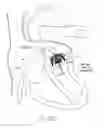 Fig. 33 - Implantable device and delivery system for reshaping a heart valve annulus