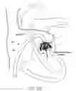 Fig. 35 - Implantable device and delivery system for reshaping a heart valve annulus