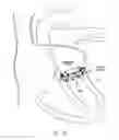 Fig. 43 - Implantable device and delivery system for reshaping a heart valve annulus