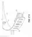 Fig. 43 - Coiling implantable prostheses