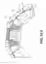 Fig. 65 - Coiling implantable prostheses