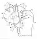 Fig. 01 - Bone preserving intraoperative downsizing system for orthopaedic implants