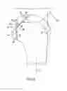 Fig. 06 - Bone preserving intraoperative downsizing system for orthopaedic implants