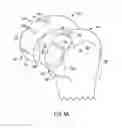 Fig. 08 - Bone preserving intraoperative downsizing system for orthopaedic implants