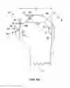 Fig. 09 - Bone preserving intraoperative downsizing system for orthopaedic implants