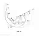 Fig. 11 - Bone preserving intraoperative downsizing system for orthopaedic implants