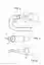 Fig. 03 - Devices and Methods for Anchoring an Endoluminal Sleeve in the GI Tract