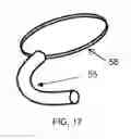 Fig. 06 - Devices and Methods for Anchoring an Endoluminal Sleeve in the GI Tract