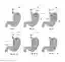 Fig. 08 - Devices and Methods for Anchoring an Endoluminal Sleeve in the GI Tract