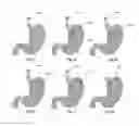 Fig. 09 - Devices and Methods for Anchoring an Endoluminal Sleeve in the GI Tract