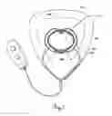 Fig. 08 - External penile erection system