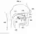 Fig. 04 - Device for moving lower jaw forward
