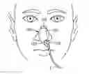 Fig. 01 - Nasogastric tube securement systems and methods of using same