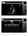 Fig. 02 - SUBSTANCE SELECTED AMONG MIDODRINE, A PHARMACEUTICAL SALT AND AN ACTIVE METABOLITE THEREOF, FOR USE IN THE TREATMENT OF OBSTRUCTIVE CARDIOPATHY