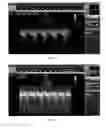 Fig. 04 - SUBSTANCE SELECTED AMONG MIDODRINE, A PHARMACEUTICAL SALT AND AN ACTIVE METABOLITE THEREOF, FOR USE IN THE TREATMENT OF OBSTRUCTIVE CARDIOPATHY