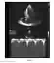 Fig. 08 - SUBSTANCE SELECTED AMONG MIDODRINE, A PHARMACEUTICAL SALT AND AN ACTIVE METABOLITE THEREOF, FOR USE IN THE TREATMENT OF OBSTRUCTIVE CARDIOPATHY