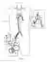 Fig. 08 - VA ECMO with pulmonary artery ventilation