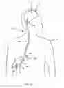 Fig. 04 - Therapeutic applications of artificial cerebrospinal fluid and tools provided therefor