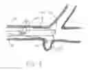 Fig. 02 - Temporary bypass balloon catheter