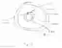 Fig. 06 - Temporary bypass balloon catheter