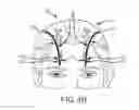 Fig. 08 - Extracranial implantable devices, systems and methods for the treatment of medical disorders