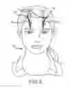 Fig. 09 - Extracranial implantable devices, systems and methods for the treatment of medical disorders