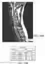 Fig. 09 - High density epidural stimulation for facilitation of locomotion, posture, voluntary movement, and recovery of autonomic, sexual, vasomotor, and cognitive function after neurological injury