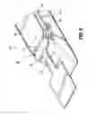 Fig. 07 - Buttress brachytherapy and integrated staple line markers for margin identification
