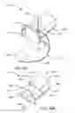 Fig. 68 - Specimen collection cassette for retrieving tissue samples from a fluid stream generated during a medical/surgical procedure