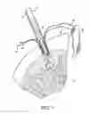 Fig. 06 - GRAFT FIXATION USING A PLUG AGAINST SUTURE
