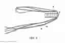 Fig. 09 - GRAFT FIXATION USING A PLUG AGAINST SUTURE