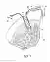 Fig. 08 - Graft fixation using a plug against suture
