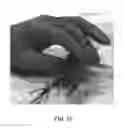 Fig. 09 - Device and method for removing occlusions in a biological vessel
