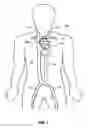 Fig. 02 - High torsion delivery catheter element