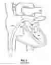 Fig. 04 - High torsion delivery catheter element