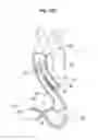 Fig. 64 - Method for replacing a heart valve
