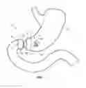 Fig. 02 - Implantable weight control device to promote early and prolonged satiety in a bariatric patient