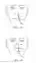 Fig. 04 - Nasogastric tube securement systems and methods of using same