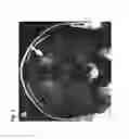 Fig. 02 - STEM CELL-DERIVED OLIGODENDROCYTE PROGENITOR CELLS FOR THE TREATMENT OF WHITE MATTER STROKE