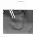 Fig. 07 - Emulsions or microemulsions for use in endoscopic mucosal resectioning and/or endoscopic submucosal dissection