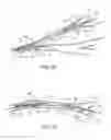 Fig. 22 - Medical device for sensing and or stimulating tissue