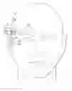 Fig. 01 - Implantable head located radiofrequency coupled neurostimulation system for head pain