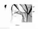 Fig. 07 - METHOD OF TREATMENT OF EYELID LAXITY