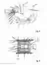 Fig. 04 - Putting-on aid for a support stocking