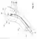 Fig. 21 - Endotracheal tube insertion device